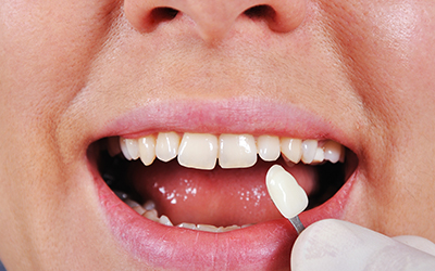 Shade determination tooth