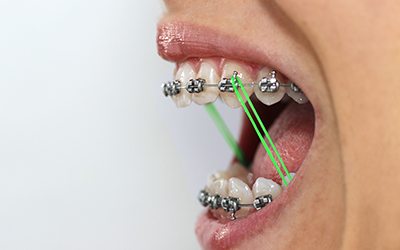Open mouth with braces and bands