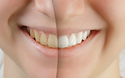 Up-close teeth showing the difference between yellow and white teeth