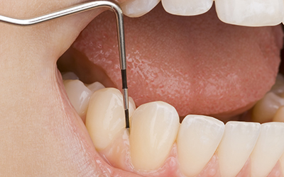 up-close of gums in a mouth